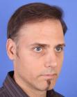 After Hair Transplant&nbsp;Revision
